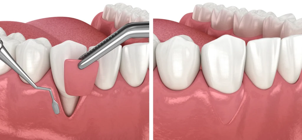 greffe gencives parodontologie chirurgicale montauban Soins des gencives (chirurgicaux) Chirurgiens-dentistes à Montauban