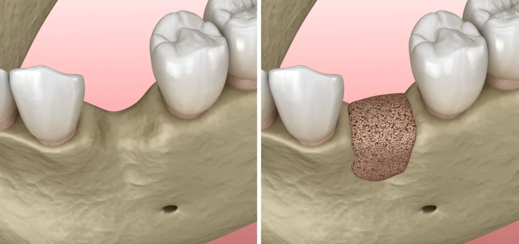 greffes osseuses parodontologie chirurgicale montauban Traitements Chirurgiens-dentistes à Montauban