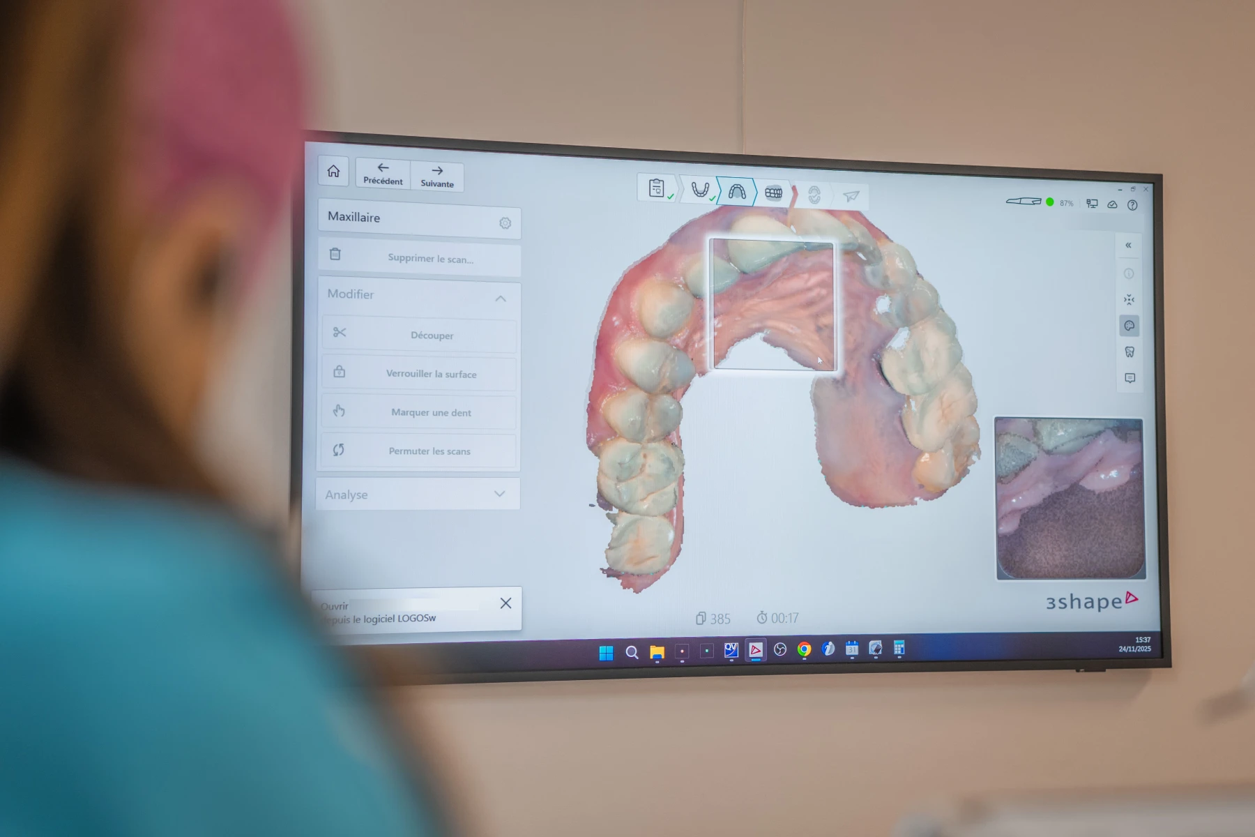 chirurgie-dentaire-implants-dentiste-montauban