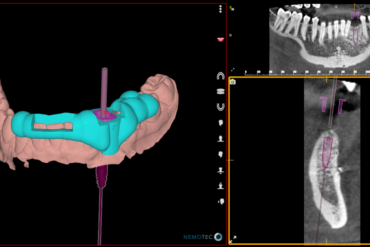 dentiste Montauban-guidee-implant