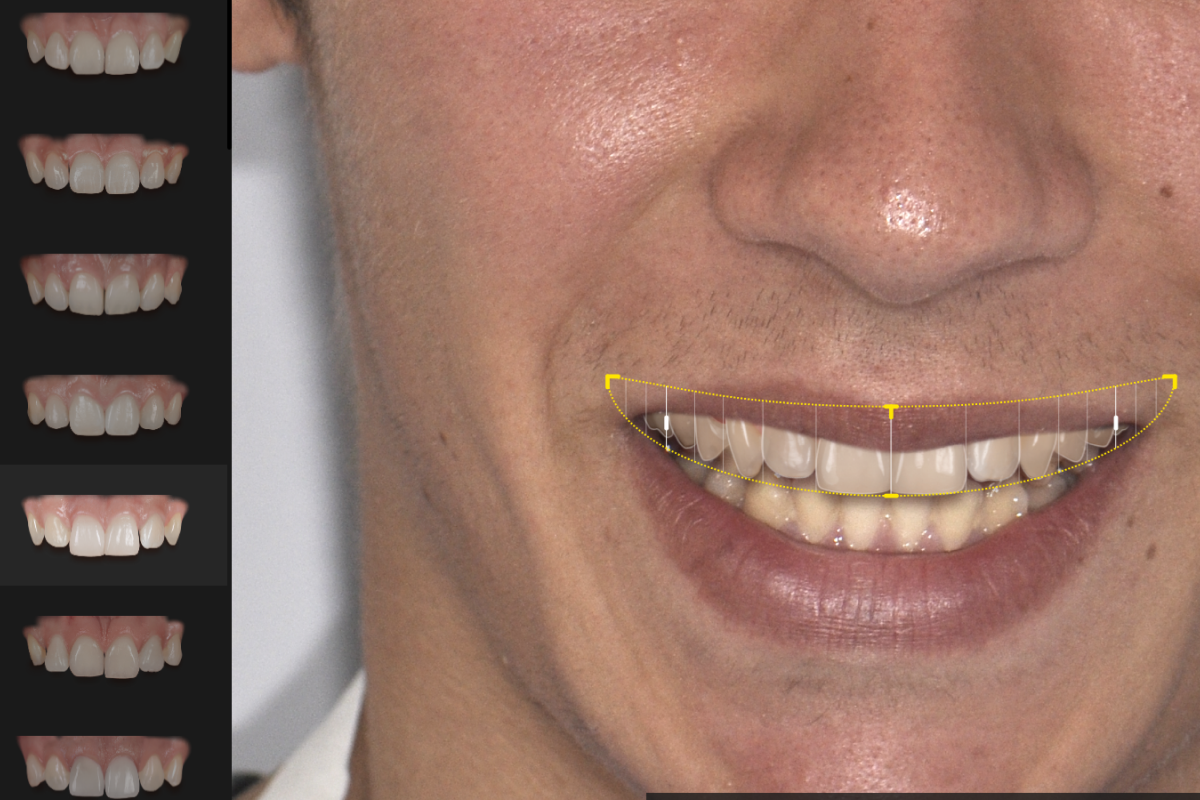 projet-esthetique-virtuel-dentiste Montauban